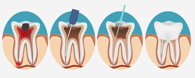 Endodonti (Kanal Tedavisi)
